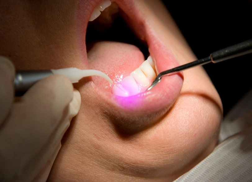 レーザーによる歯肉形成｜河野歯科