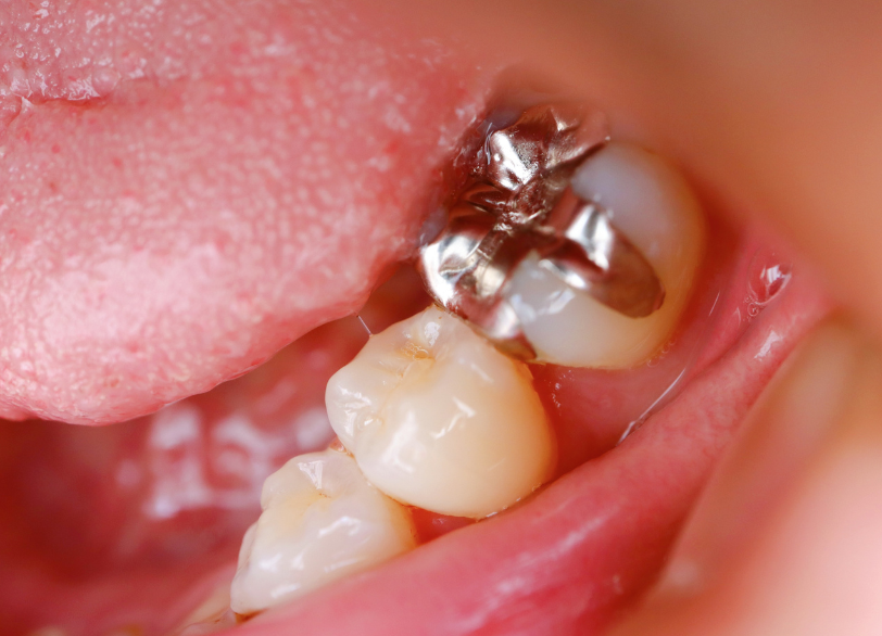 金属アレルギーから体を守る｜河野歯科