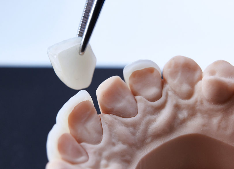 ラミネートベニア｜河野歯科