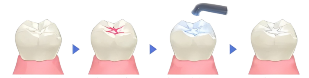 シーラント｜河野歯科