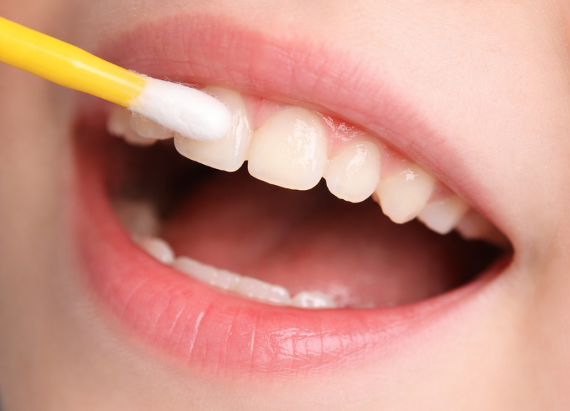 フッ素塗布｜河野歯科