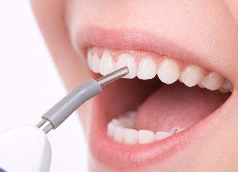 パルプテスター｜河野歯科