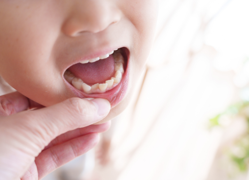 成長期だからこそできる「抜かない」ための矯正治療｜河野歯科