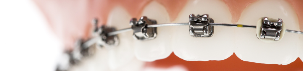 成人矯正治療の流れ｜河野歯科