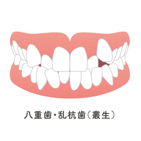 叢生（そうせい）・乱杭歯（らんぐいば）・八重歯｜河野歯科