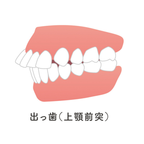 上顎前突｜河野歯科