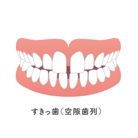 空隙歯列｜河野歯科