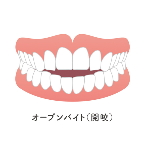 オープンバイト｜河野歯科
