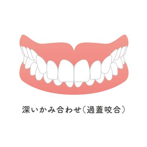 過蓋咬合｜河野歯科