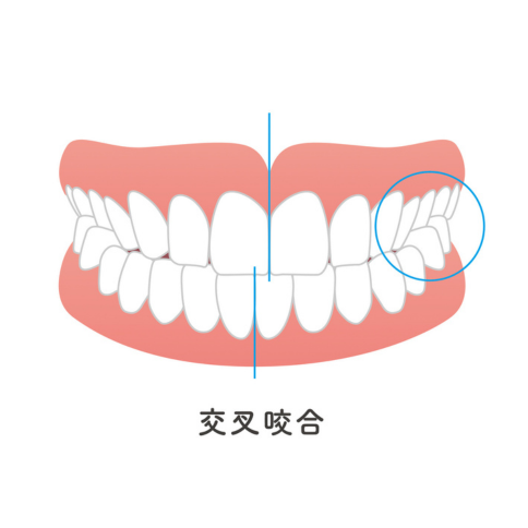 交叉咬合｜河野歯科