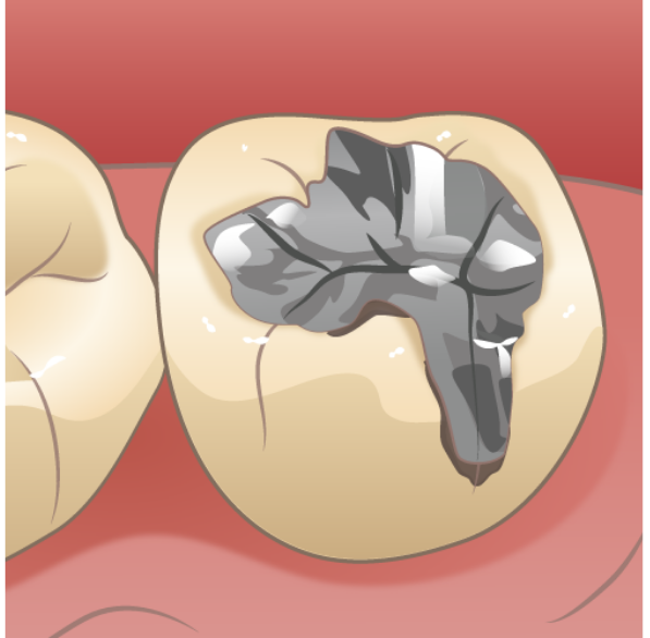 二次カリエス｜河野歯科