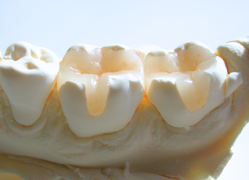 インレー・オンレー｜河野歯科