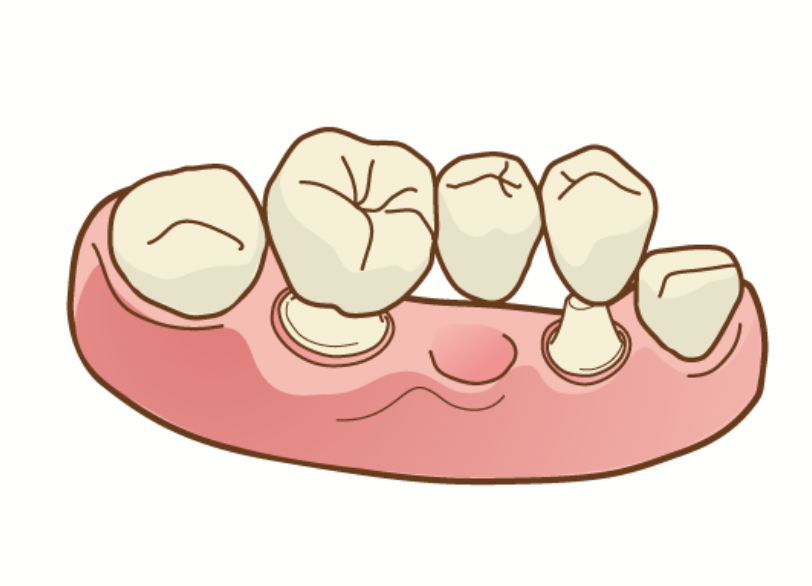 ブリッジ｜河野歯科
