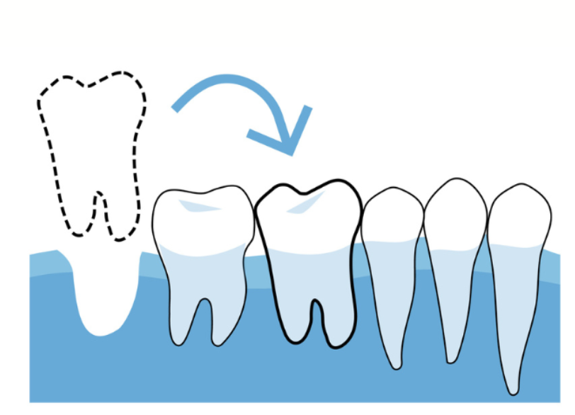 自家歯牙移植｜河野歯科
