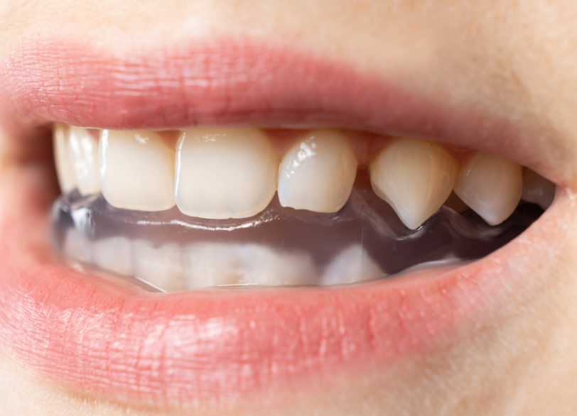 スプリント療法｜河野歯科