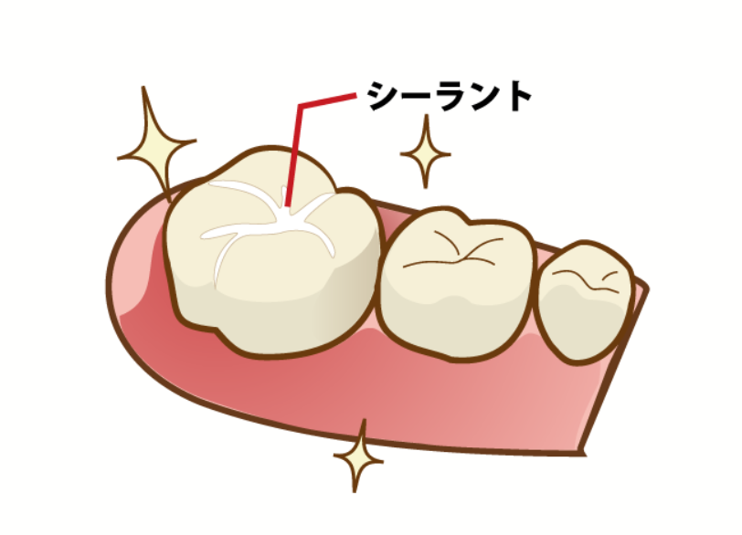 シーラント｜河野歯科