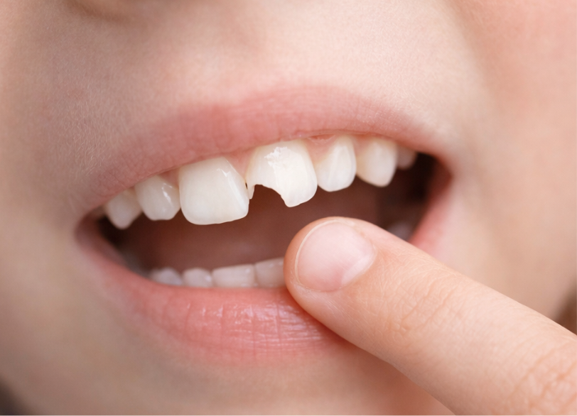 外傷（歯の破折・脱臼）｜河野歯科