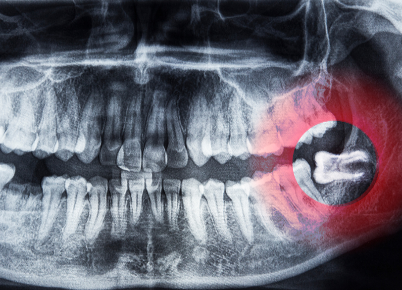 親知らずの抜歯｜河野歯科
