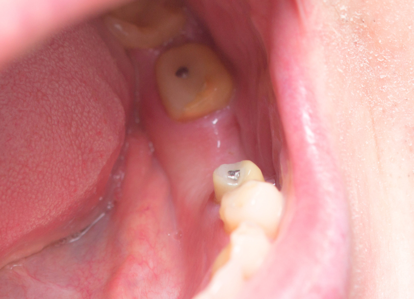 残っている健康な歯を守るために｜河野歯科