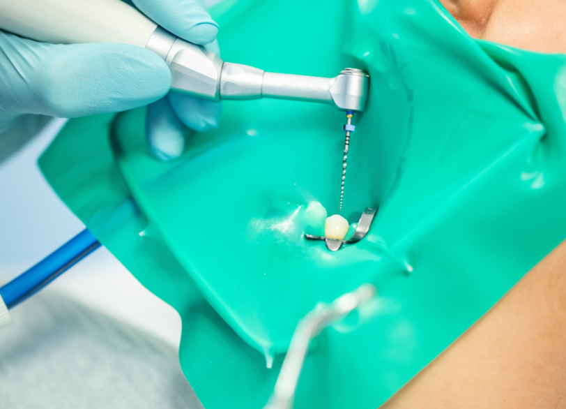 エンドモーター｜河野歯科