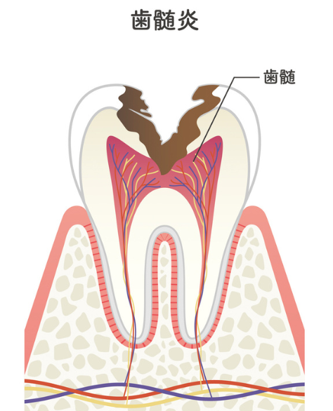 歯髄炎｜河野歯科