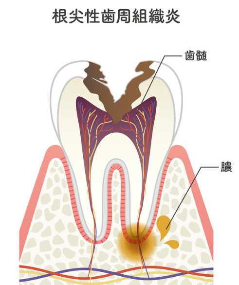 根尖性歯周炎｜河野歯科