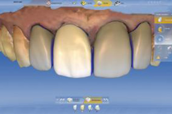 河野歯科クリニック　セレック治療