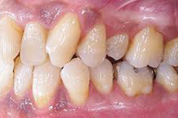 河野歯科クリニック 歯周病治療