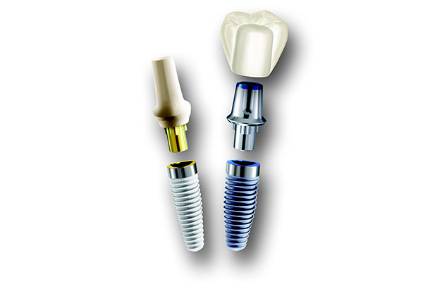 河野歯科クリニック インプラント治療