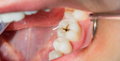 虫歯治療｜河野歯科