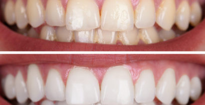 ホワイトニング｜河野歯科