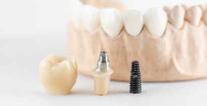 インプラント治療｜河野歯科