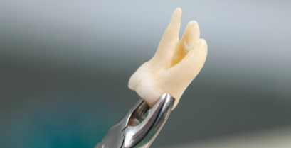 口腔外科・親知らず治療｜河野歯科