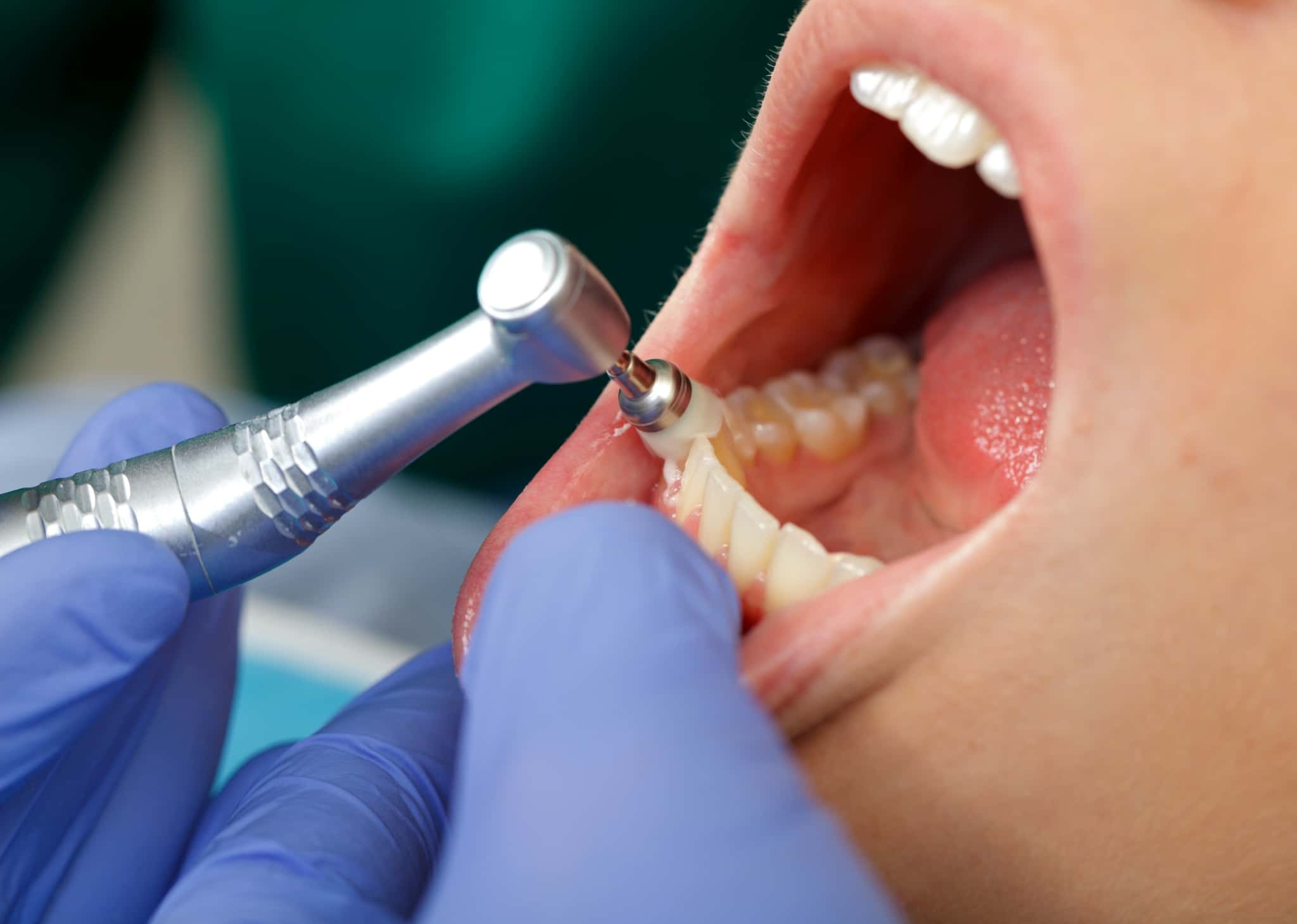 ホワイトニングの効果を長持ちさせるために歯科医院でクリーニングをしている様子