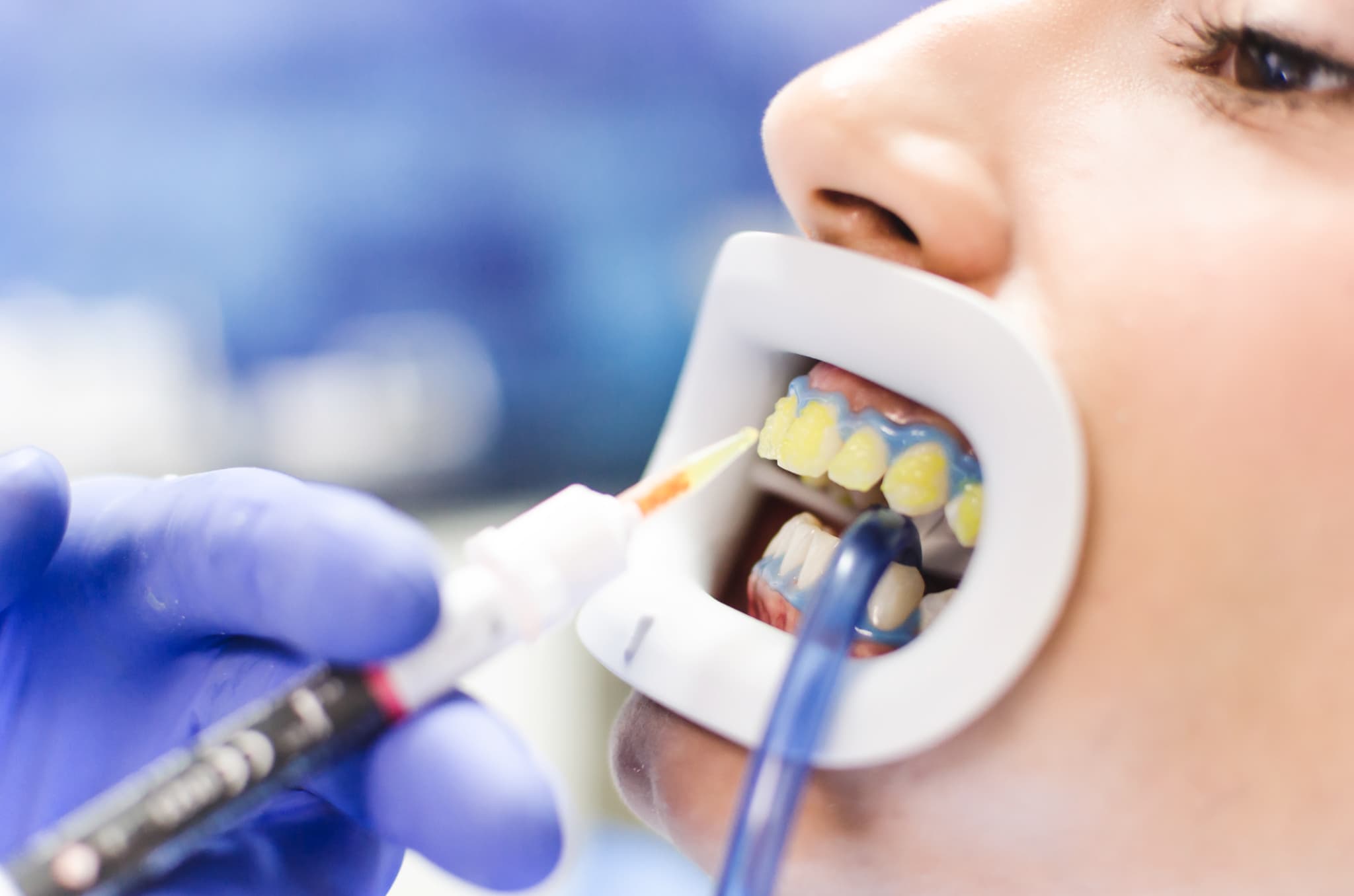 ホワイトニングの薬剤を塗布する様子