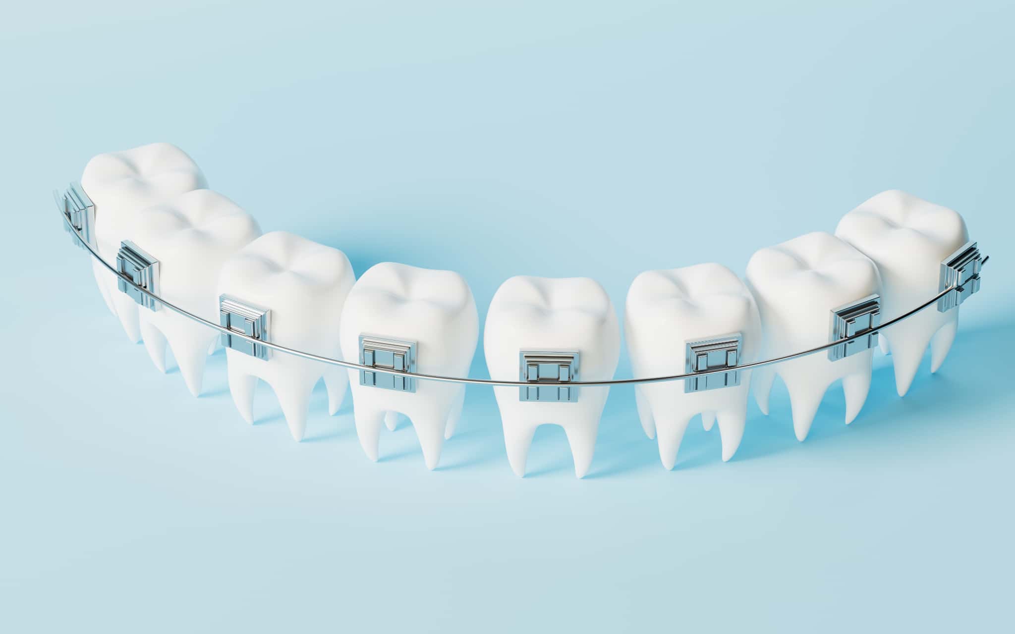 ワイヤー矯正のイメージ