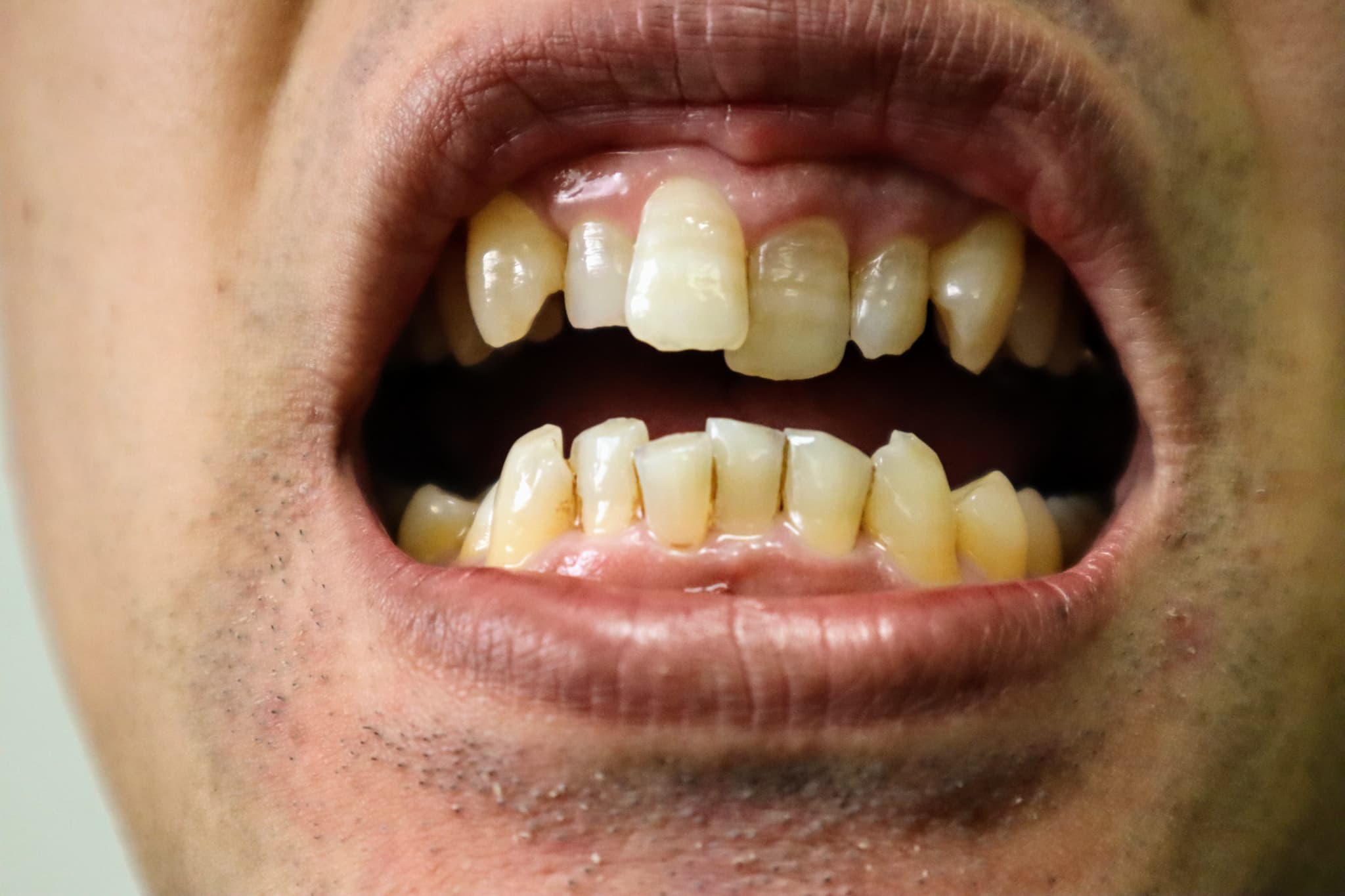 黄ばんだ悪い歯並びのイメージ