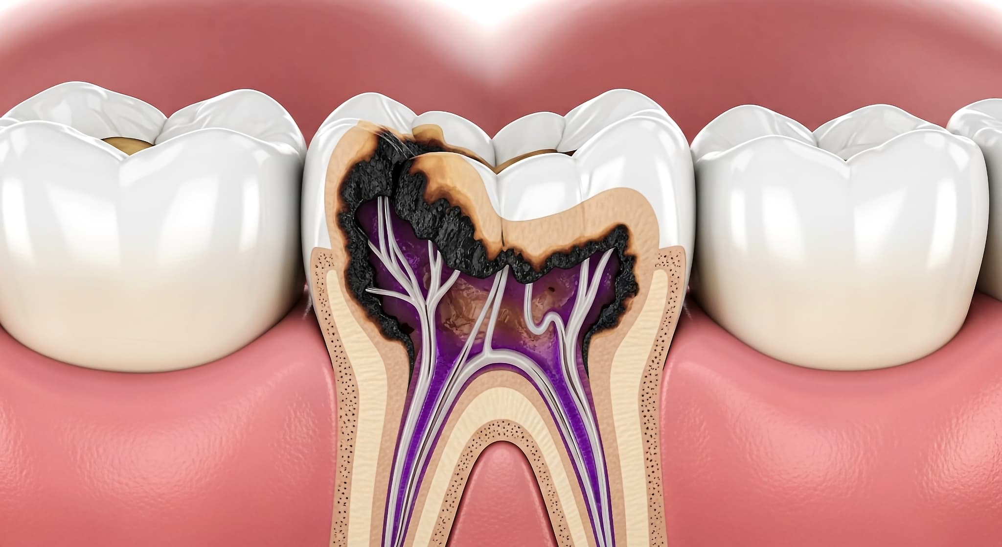 虫歯になった歯の内部