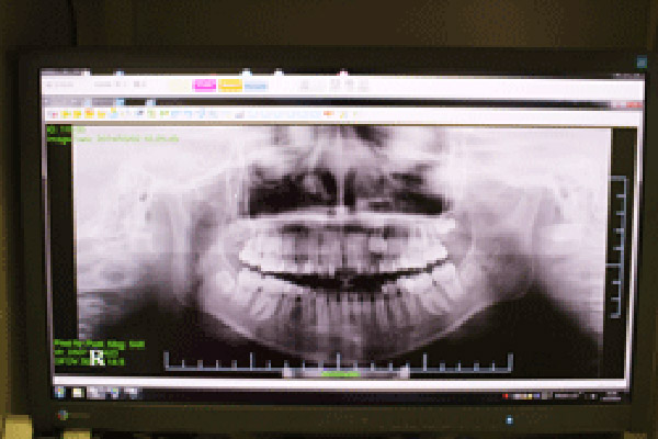 デジタルレントゲン｜河野歯科