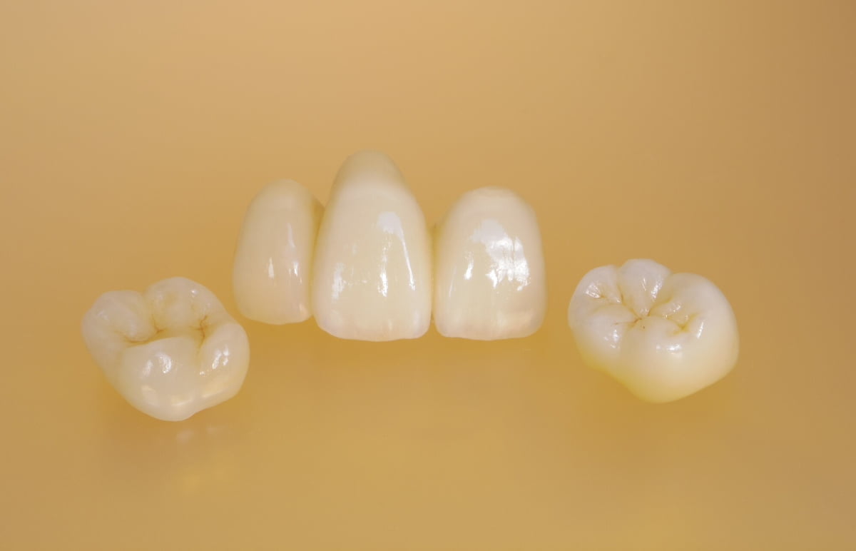 歯の治療に使用する差し歯